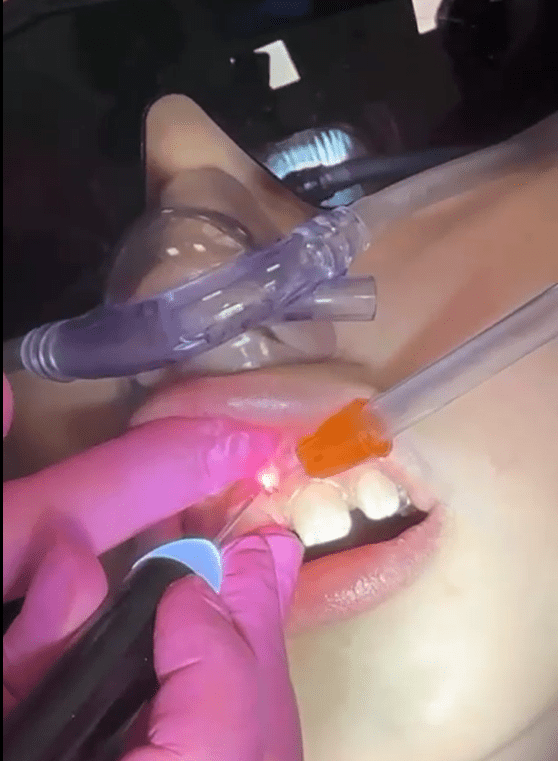 Quando a frenectomia infantil com laser é indicada?